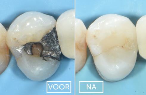 eenvoudige vulling