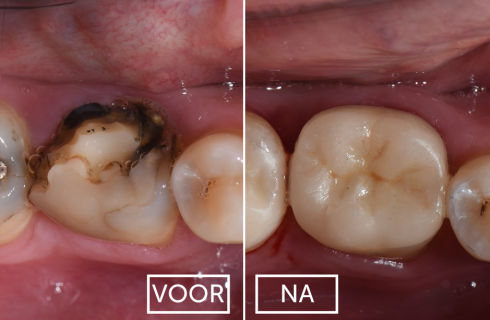 keramische restauratie